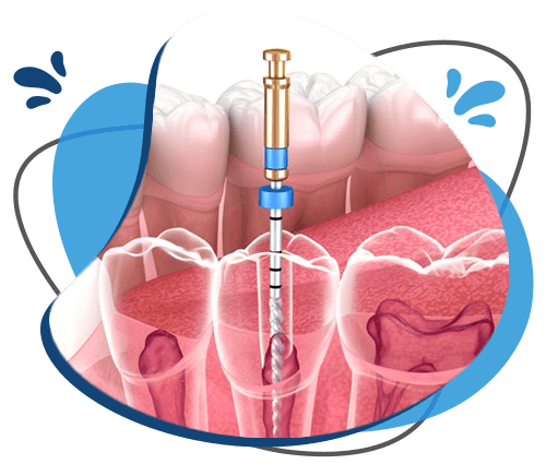 Endodoncia