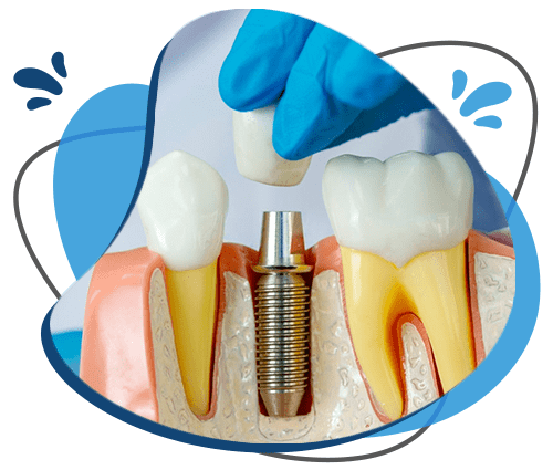 Periodoncia e Implantes